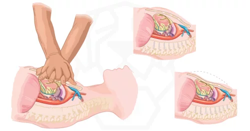 Una solución eficaz para la reanimación cardiaca